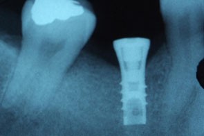 implants-specialiste de l'implant en Algérie