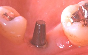 Spécialiste de l'implant à ALGER