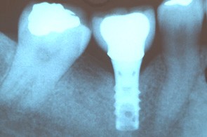 Spécialiste en implant sur ALGER